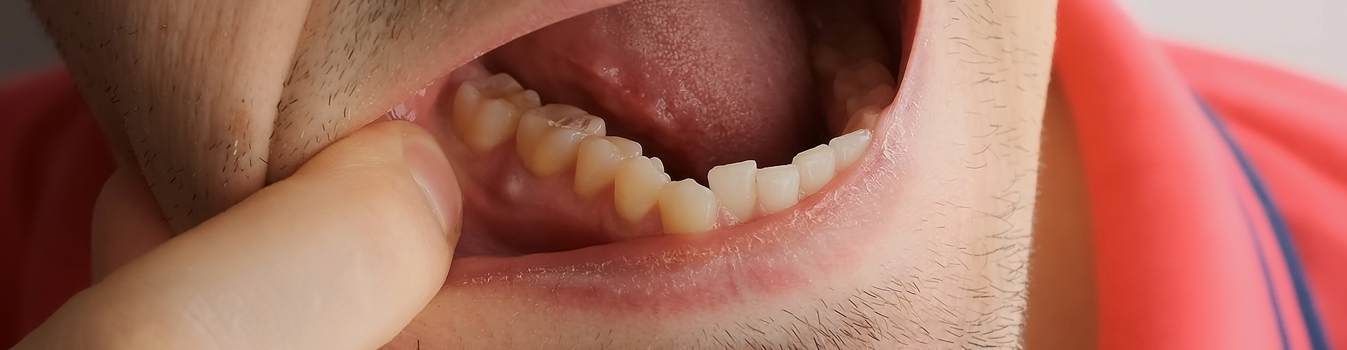 man pulling down lower lip to show inflamed gum